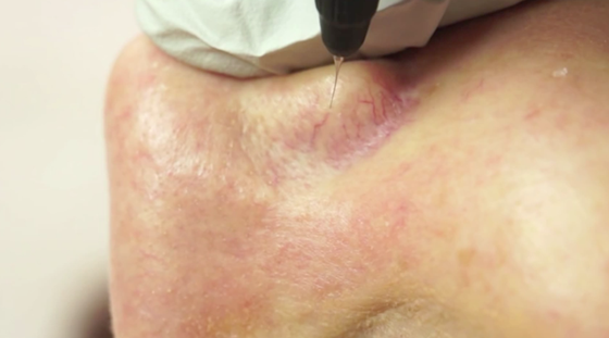 Facial Telangiectasia: Alastair Lewis Veins