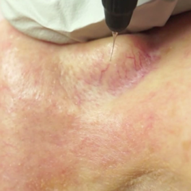 Facial Telangiectasia: Alastair Lewis Veins