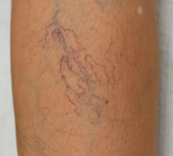 Spider Veins and Thread veins:  Alastair Lewis Veins