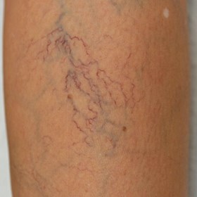 Spider Veins and Thread veins:  Alastair Lewis Veins