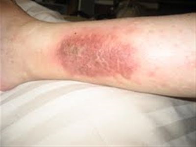 Chronic venous insufficiency : Alastair Lewis Veins