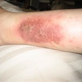 Chronic venous insufficiency : Alastair Lewis Veins